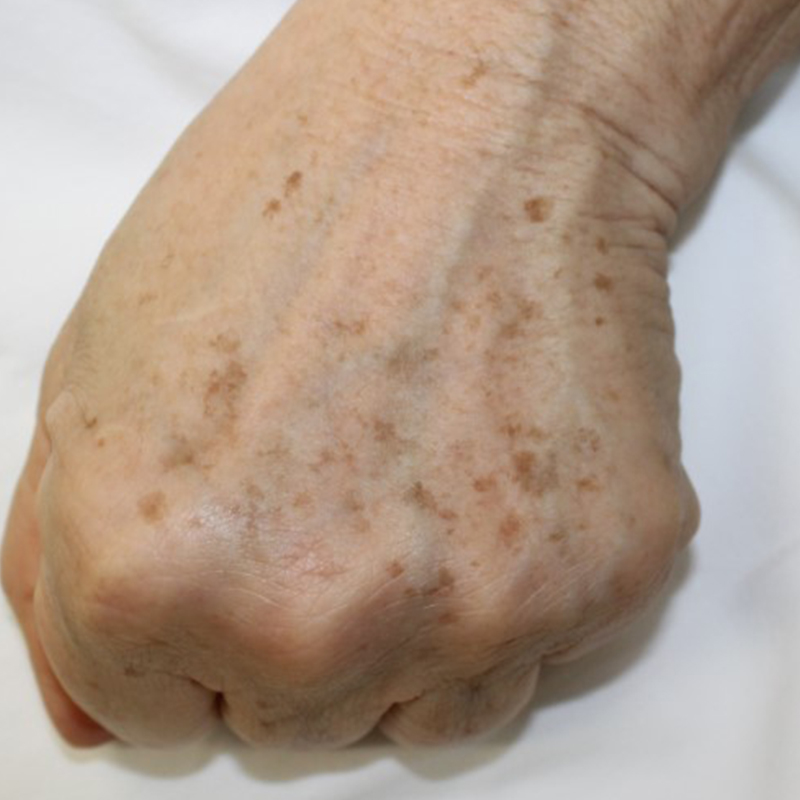 Manchas Nas Mãos Instituto Dermatológico